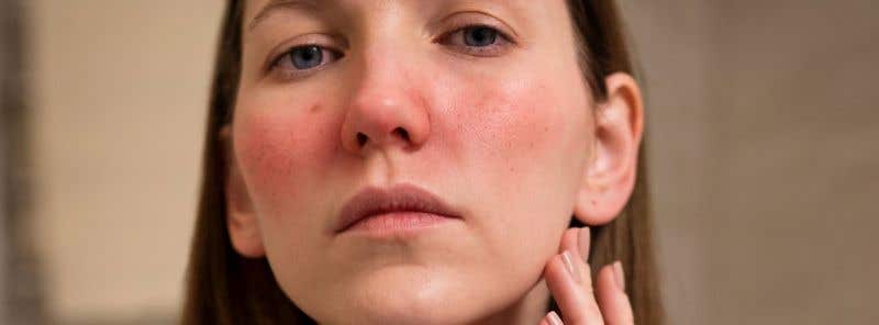 Rosacea alebo ružovka. Príznaky, spúšťače a účinné tipy na liečbu